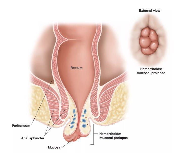 Warm baths to alleviate hemorrhoid discomfort