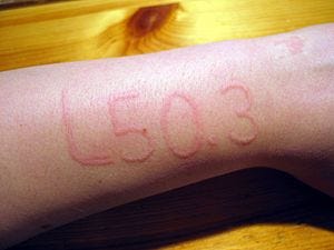 Image of skin showing dermatographic urticaria